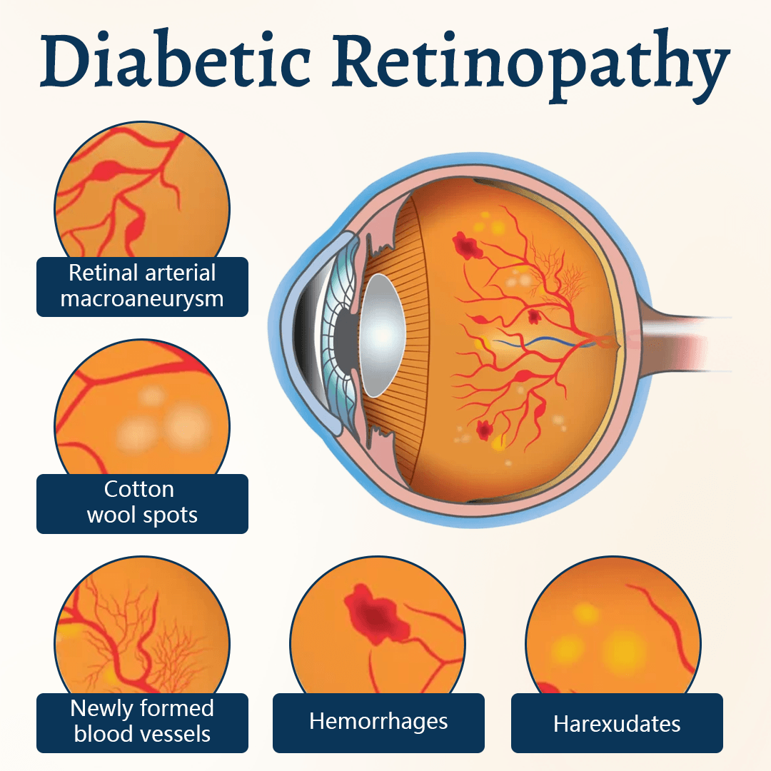 Patch ocular Relieflogix OptiFusion Vision Support