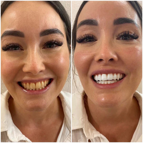 Caneta de gel clareadora dental Biancat® PearlWhite