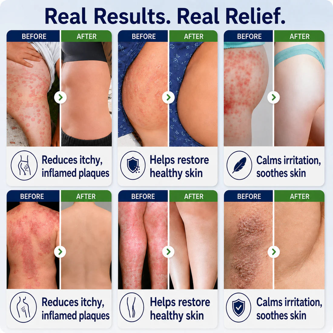 Spray 2 em 1  | Alívio rápido para psoríase e eczema (seguro para o corpo todo e áreas íntimas)