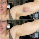 Timilk® BruiseFade ProCreme para Eliminar Hematomas, Reduzir Manchas Roxas e Acelerar a Recuperação da Pele