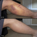 Timilk® BruiseFade ProCreme para Eliminar Hematomas, Reduzir Manchas Roxas e Acelerar a Recuperação da Pele