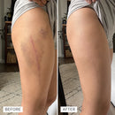 Timilk® BruiseFade ProCreme para Eliminar Hematomas, Reduzir Manchas Roxas e Acelerar a Recuperação da Pele