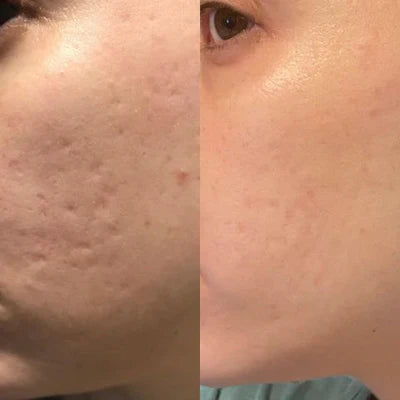 HyaRepair | Fita de Silicone para Rugas e Cicatrizes