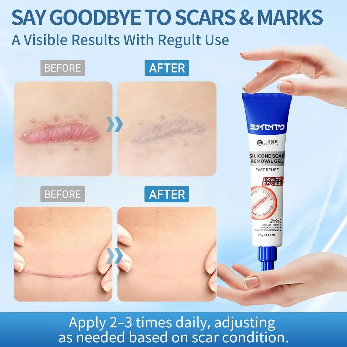 Gel de silicone para cicatrizes