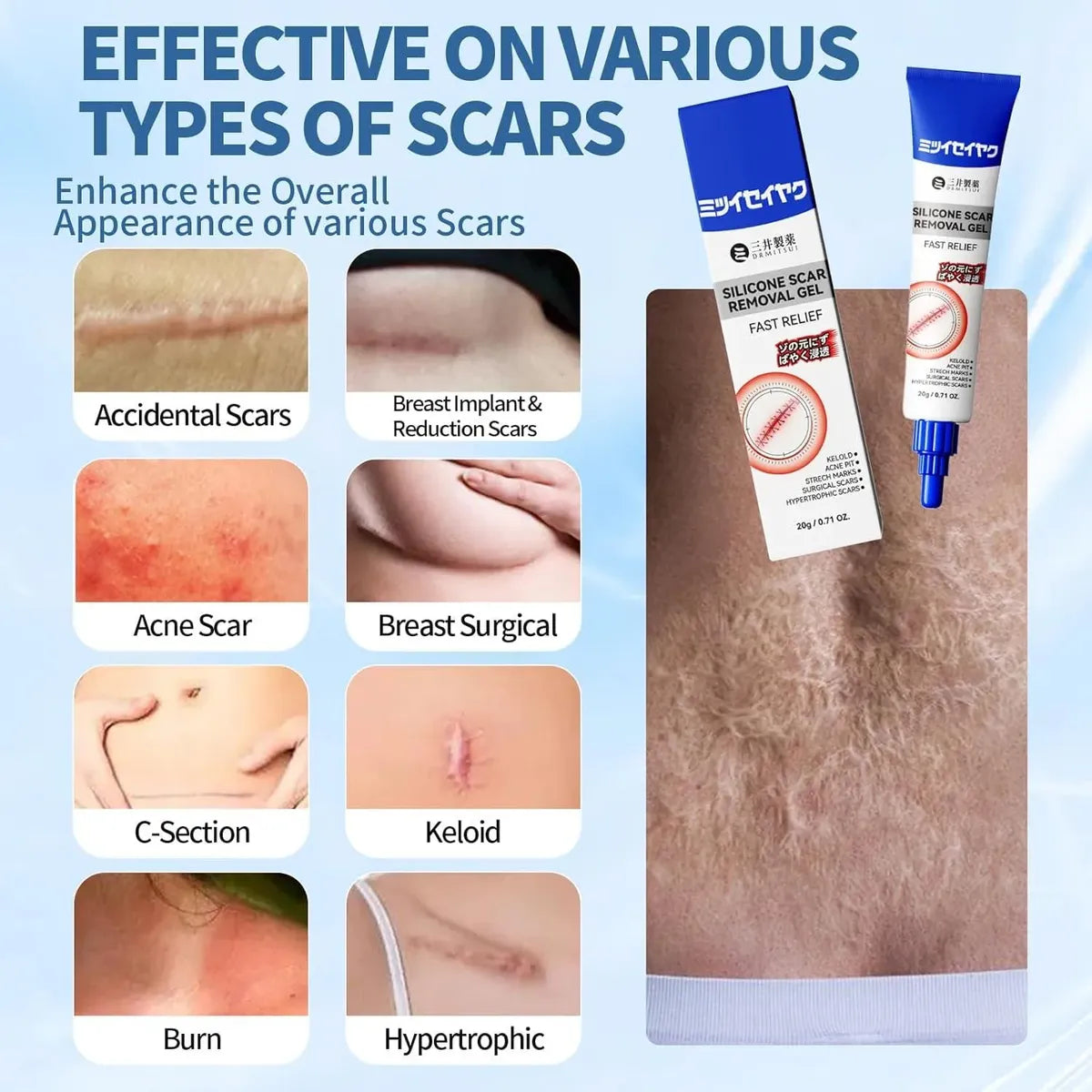 Gel de silicone para cicatrizes