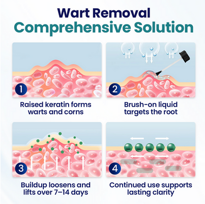Timilk WartLift Corn Removal Liquid - removedor líquido para: Calos, Verrugas, Calosidades, Verrugas plantares (olho de peixe)