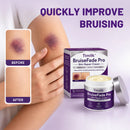 Timilk® BruiseFade ProCreme para Eliminar Hematomas, Reduzir Manchas Roxas e Acelerar a Recuperação da Pele