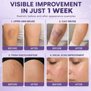 Timilk® BruiseFade ProCreme para Eliminar Hematomas, Reduzir Manchas Roxas e Acelerar a Recuperação da Pele