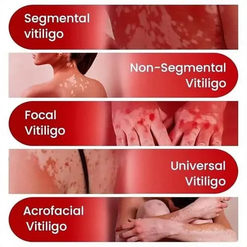 Spray para tratamento de vitiligo, removedor de manchas