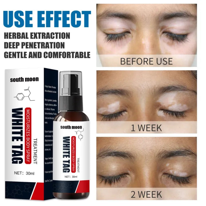 Spray hidratante original South Moon White Tag com óleo de mostarda para tratamento de vitiligo 30ml