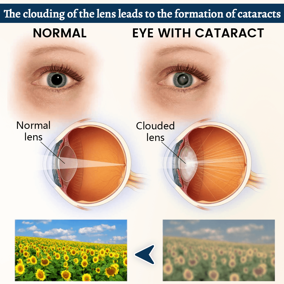 Patch ocular Relieflogix OptiFusion Vision Support