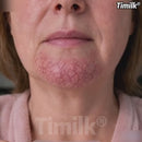 Rolo de adesivos de microagulhas Timilk para tratamento de varizes